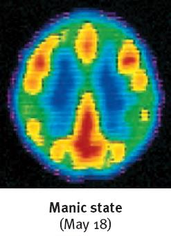 Brain scan: Manic state (May 18)