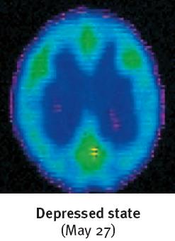 Brain scan: Depressed state (May 27)