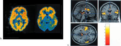 fMRI scan of brain activity