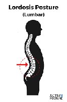 Lordosis posture