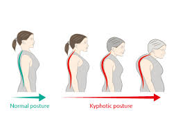 Normal vs kyphotic posture
