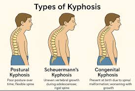 Types of kyphosis