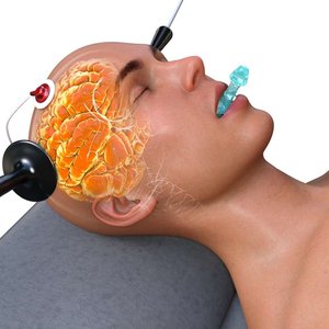 Early ECT treatment