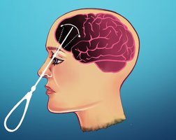 Illustration of prefrontal lobotomy