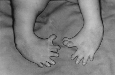 Thalidomide-induced limb malformations