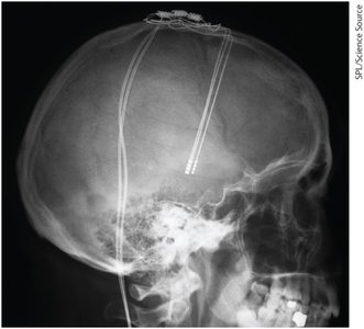 Deep brain stimulation x-ray