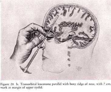 Transorbital leucotomy illustration