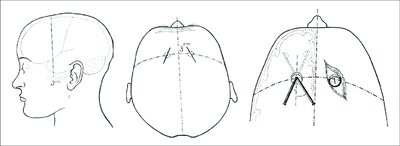 Surgical planning for brain lesion