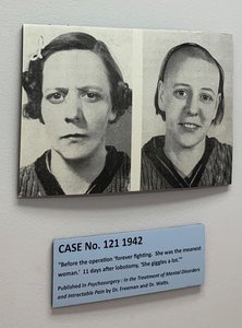 Pre- and post-lobotomy patient photo