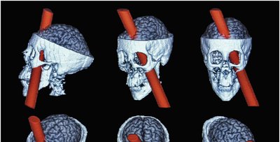 Phineas Gage injury