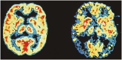 PET scan brain images
