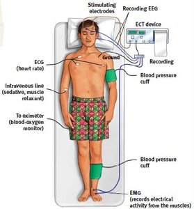 Electroconvulsive Therapy (ECT) procedure