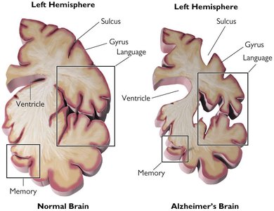 Comparison of normal and Alzheimer's brain