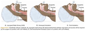 Airway management methods: LMA, nasal, and oral intubation