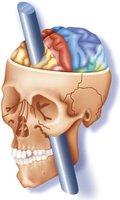 Phineas Gage skull illustration