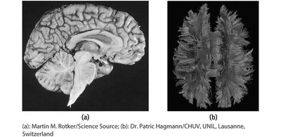 Brain imaging of corpus callosum