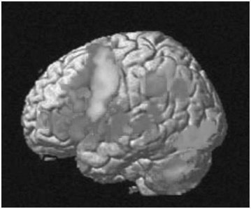 3D MRI image of the brain