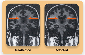 MRI scans showing enlarged ventricles in schizophrenia