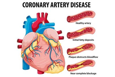 Coronary artery disease diagram