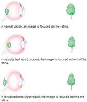 Comparison of normal vision, myopia, and hyperopia with diagrams showing image focus points