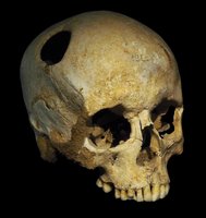 Skull with evidence of trepanation