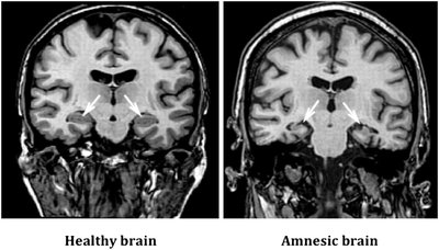 MRI comparison of healthy and amnesic brain