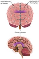 Corpus callosum