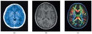 Structural neuroimaging: CT, MRI, DTI
