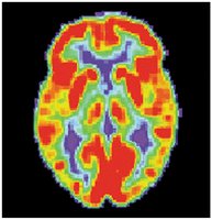 PET scan of brain activity